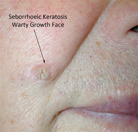 Seborrheic Keratosis Face Removal