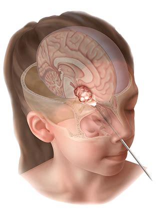 Surgery for a Craniopharyngioma | Weill Cornell Brain and Spine Center