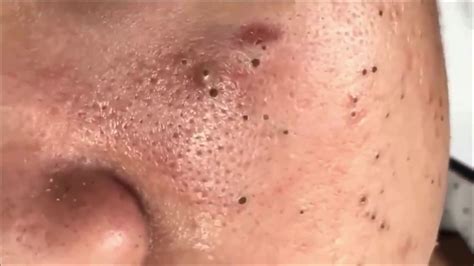 Extracting Blackheads On the Face easy #57 _ Acne Treatment - YouTube