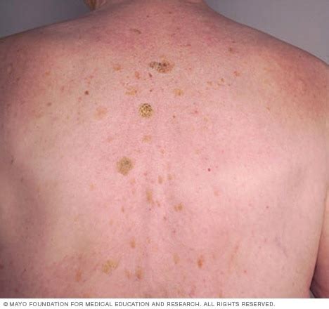 Seborrheic keratosis - Symptoms & causes - Mayo Clinic