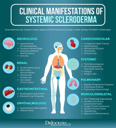 Scleroderma: Causes, Symptoms, and Natural Support Strategies ...