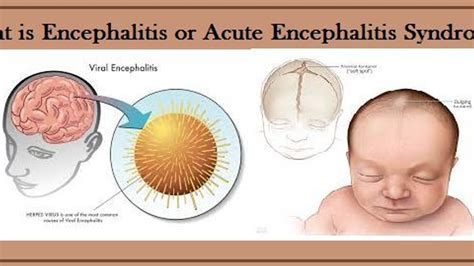 Encephalitis Symptoms