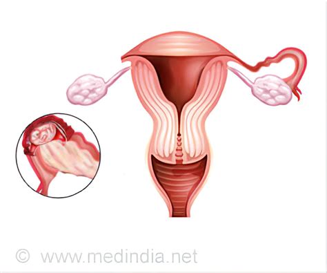 Salpingectomy - Types, Indications, Procedure, Complications