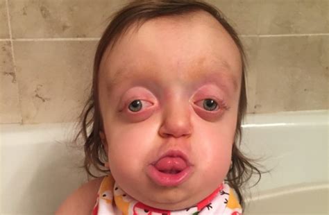 Girl born with severely deformed head smiles despite strangers ...