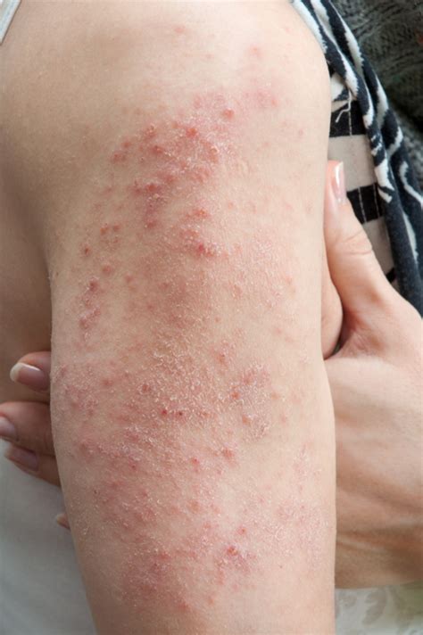 I’m Not Sure Why I Keep Getting Hives | University of Utah Health