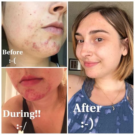 (4) Before and After using Retin-A (Tretinoin 0.025%) never-ending ...