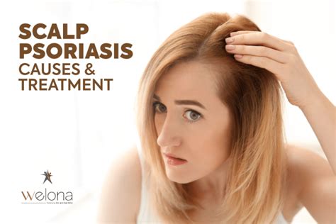 Scalp Psoriasis: Causes and Treatment