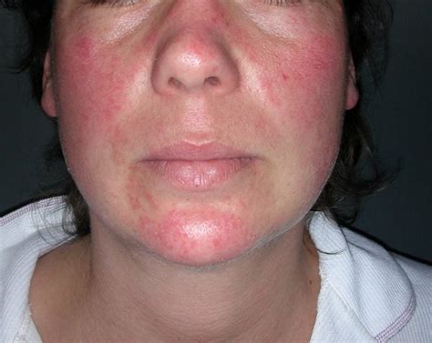 Hyperthyroidism Rash