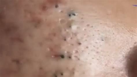 Extreme Blackhead Popping Youtube 2024 New Videos Youtube - Alfy Louisa