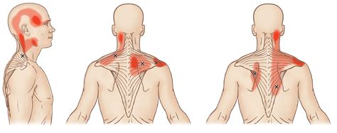 Fysiotherapie NP