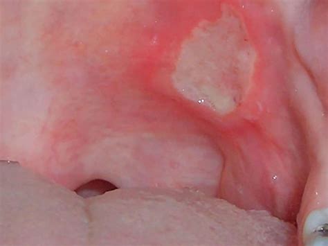 Mouth Ulcers On Tongue