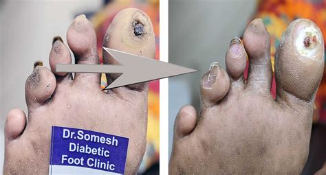 Diabetic Foot Gangrene stages Great Toe Tip - Podiatry Doctor