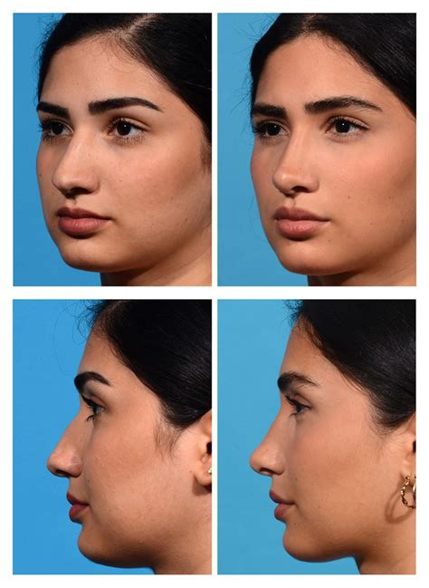 Bulbous Nose Rhinoplasty Before And After