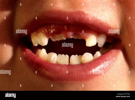 missing teeth smile model Released Stock Photo - Alamy