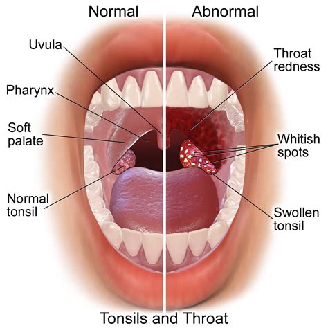 Sore throats and tonsillitis | ENT Specialist Singapore