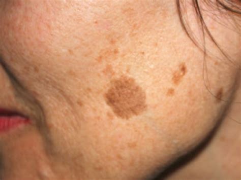 Age Liver Spots: Symptoms, Causes, Treatment Toronto Dermatology Centre ...