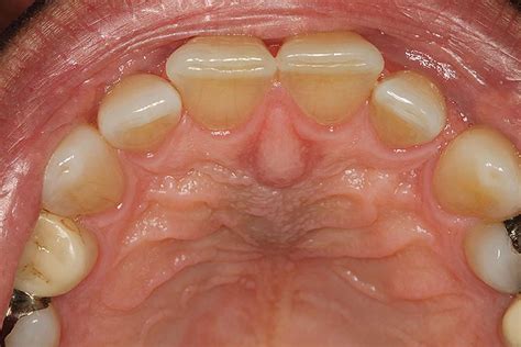 Nasopalatine duct cyst causes, symptoms, diagnosis & treatment