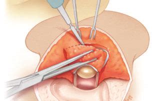 Postauricular Meatoplasty – Oto Surgery Atlas