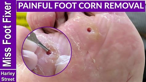 Corn On My Foot Removal Clearance | emergencydentistry.com