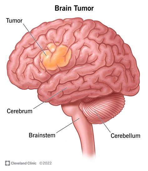 Brain Tumor: Symptoms, Signs & Causes