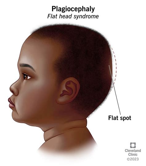 Plagiocephaly, Positional Plagiocephaly, Flat Head