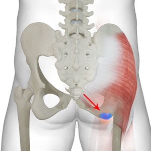 Ischial Bursitis