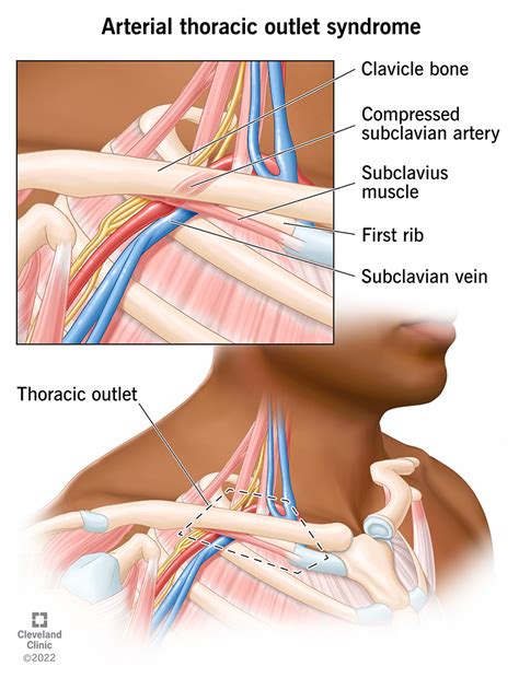 Arterial Thoracic Outlet Syndrome: Causes & Symptoms