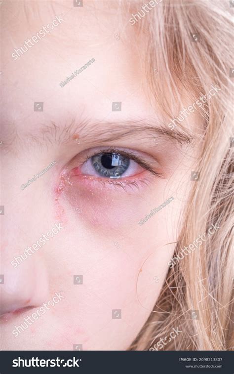 22 Crusty Eyes Baby Images, Stock Photos & Vectors | Shutterstock