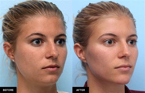 Jawline Filler for Definition & Contour (Updated 2023) – Mabrie Facial ...