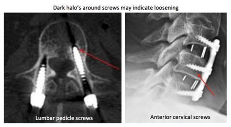 Why Are My Screws Loose? - Rocky Mountain Brain and Spine Institute