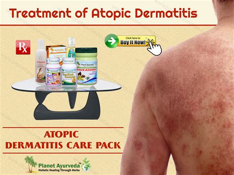 Treatment of Atopic Dermatitis with Natural Herbal Remedies