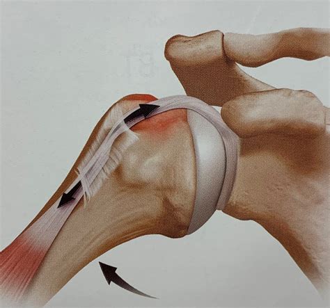 Biceps tenodesis rehab protocol