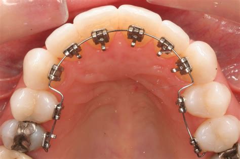 Orthodontics – Braces & Lingual Braces (invisible) - Advanced Dental ...