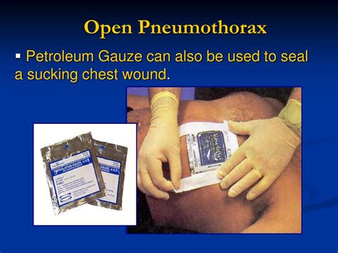 PPT - Treating Open and Closed Chest Wounds PowerPoint Presentation ...