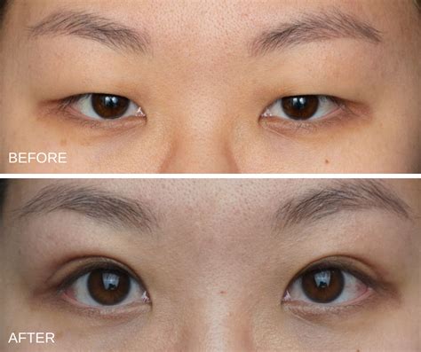 What's involved in Asian Blepharoplasty? - ASAPS