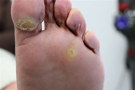 Foot Corn vs. Plantar Wart: Key Differences