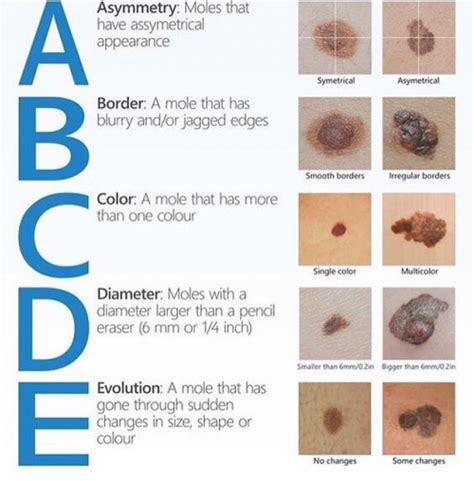 ABCDEs of Melanoma - Horizon Dermatology & Cosmetic Center - Horizon ...