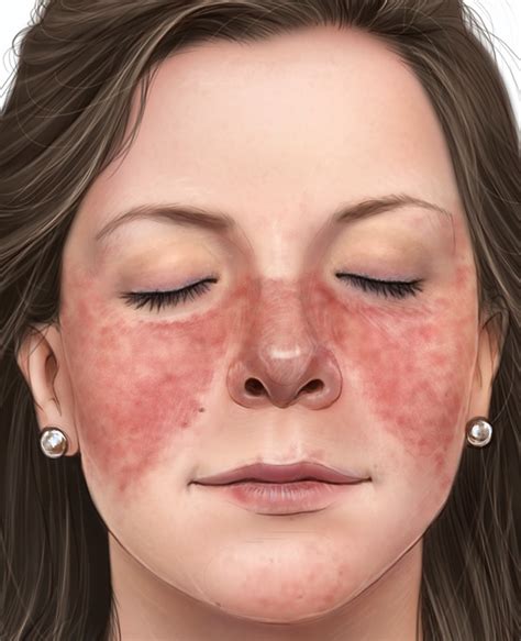 Autoimmune Disease Skin Rash On Face - Printable Templates Protal