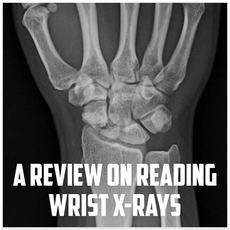 A Review on Reading Wrist X-rays - Sports Medicine Review