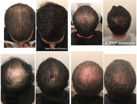 PRP Hair Loss Treatment | Sydney, Melbourne & Brisbane