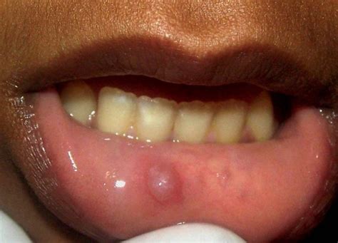 Pictures, Causes, Symptoms & Treatment of Oral Mucocele - HubPages