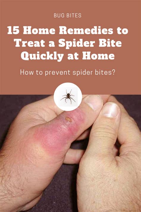 15 Home Remedies to Treat a Spider Bite Quickly at Home | Spider bites ...