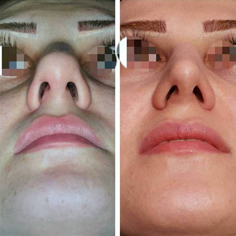 Before And After Bulbous Tip Rhinoplasty » Rhinoplasty: Cost, Pics ...