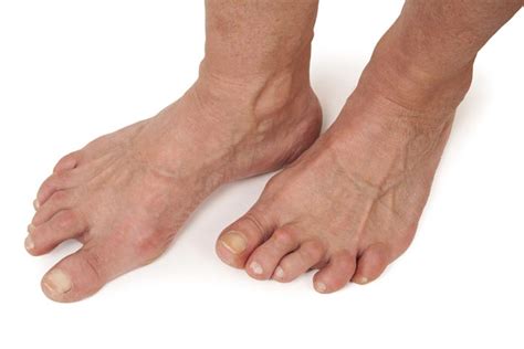 What Causes Foot Deformities? – Hairy Marys Bucks County