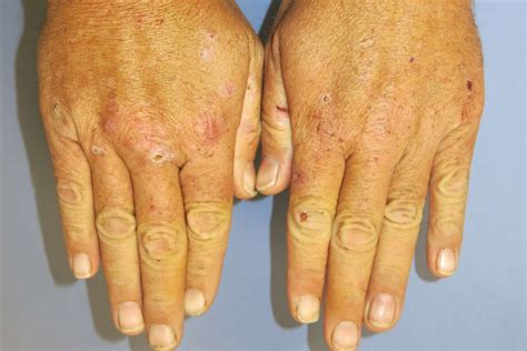 Hepatitis Rash: Causes, Symptoms, and Treatment