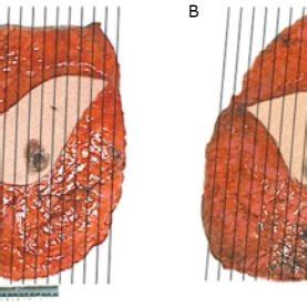 Case two. Breast mastectomy specimens and the dissection method: right ...