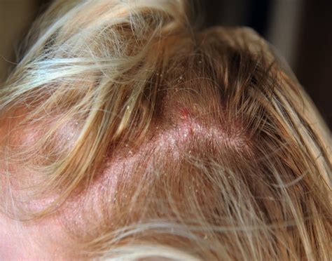 Red Spots On Scalp: Pictures, Causes, And Treatments | vlr.eng.br