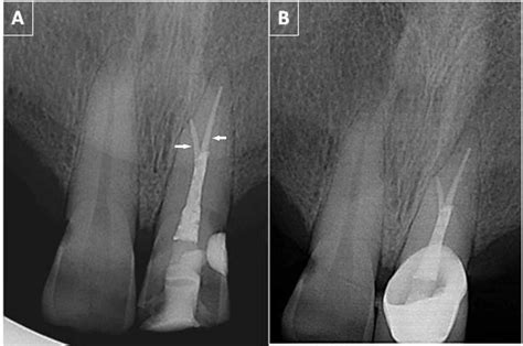 Cureus | Endodontic Management of Maxillary Central Incisor with Rare ...