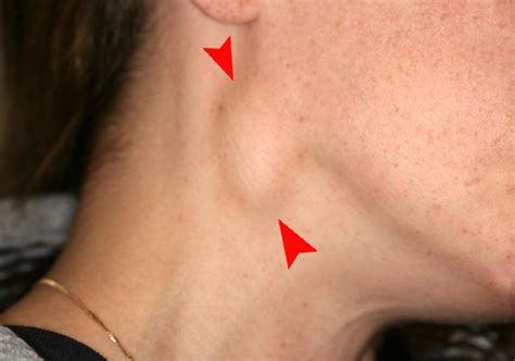 Throat Cancer Lump On Outside Of Neck