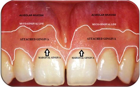 Marginal (free) gingiva, attached gingiva and alveolar mucosa ...